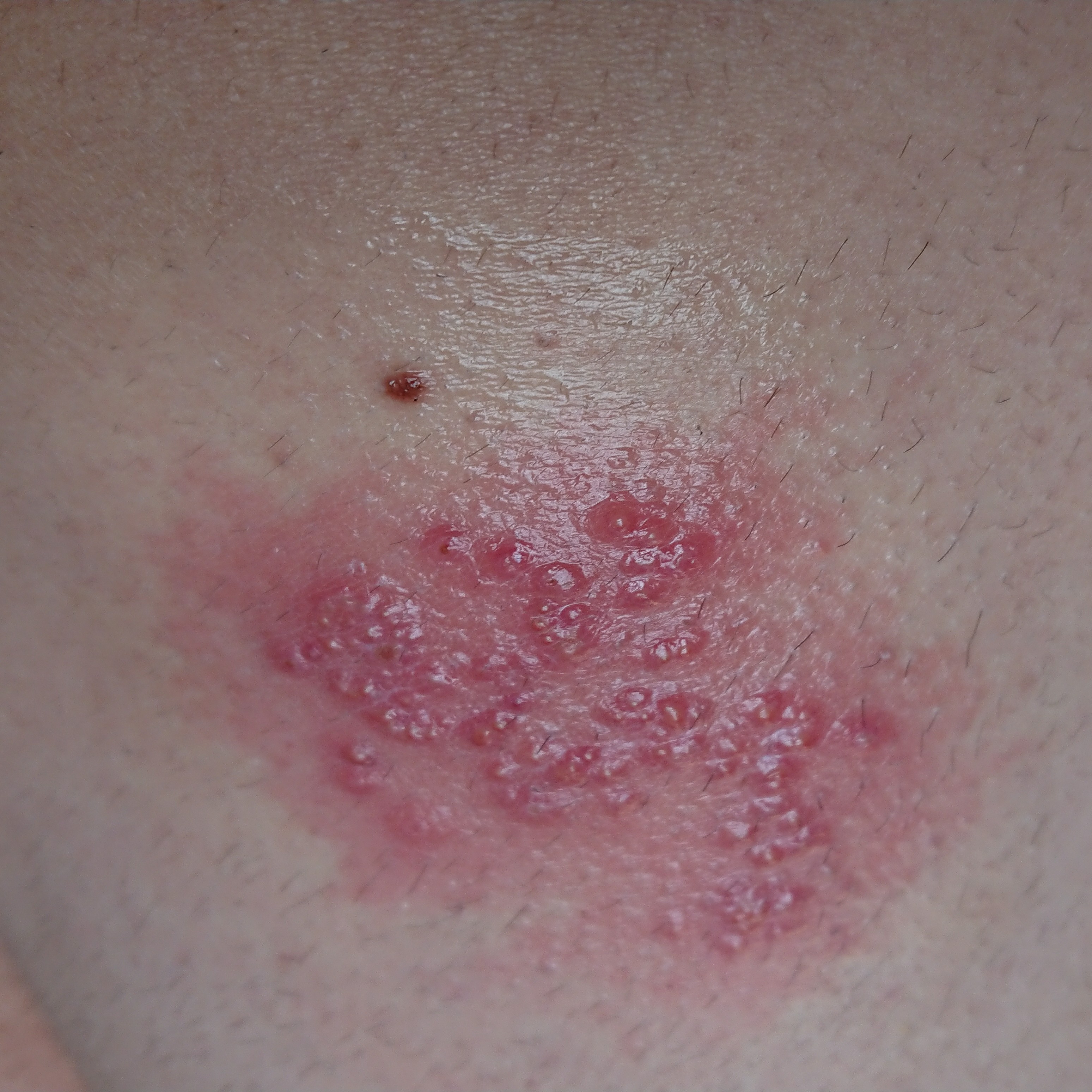 Was ist das für ein Ausschlag (Bild)? Welche Salben helfen? Muss ich
